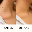 Caneta Laser MediSkin™ – Remove Manchas e Verrugas sem Dor