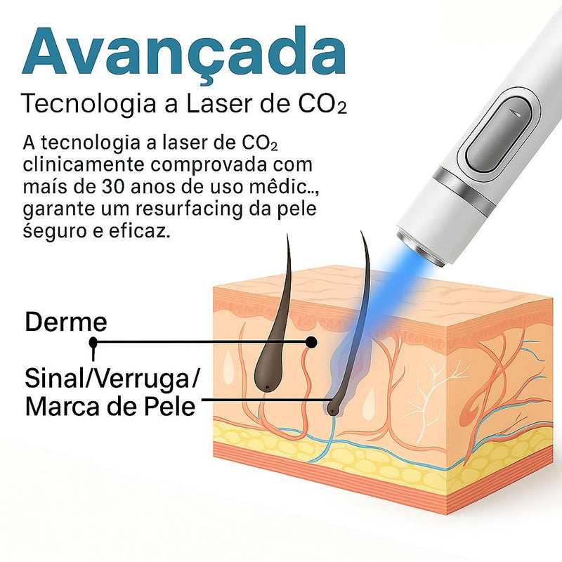 Caneta Laser MediSkin™ – Remove Manchas e Verrugas sem Dor