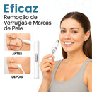 Caneta Laser MediSkin™ – Remove Manchas e Verrugas sem Dor