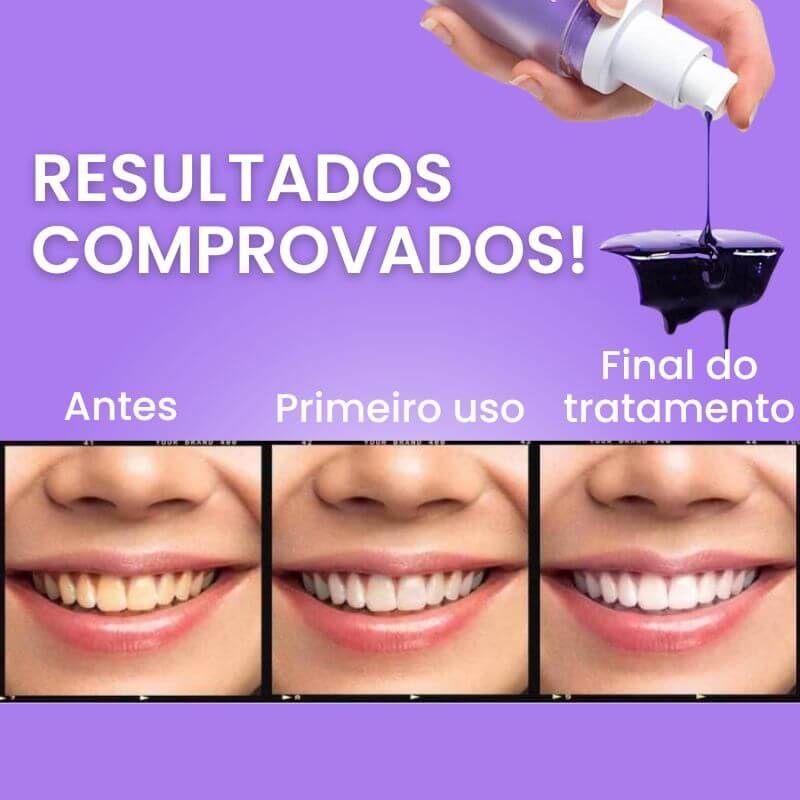 Clareador Dental iziSmile - Dentes Brancos Em Segundos [Desconto + Entrega Gratis Hoje]