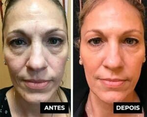 LuteinaRoll 5 em 1 ORIGINAL- Remove Olheiras, Reduz Bolsas e Revitaliza a Pele ao Redor dos Olhos