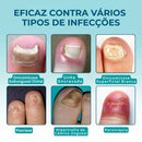 UngiGel - Adesivos para fungos